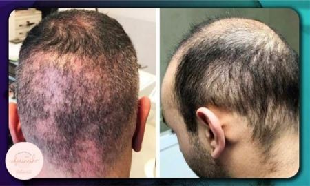 نشان های کاشت مو ناموفق نشان های کاشت مو ناموفق