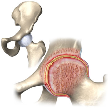 آرتروز زانو, سیستمایمنی بدن, علایم آرتریت عفونی آرتروز زانو, سیستمایمنی بدن, علایم آرتریت عفونی